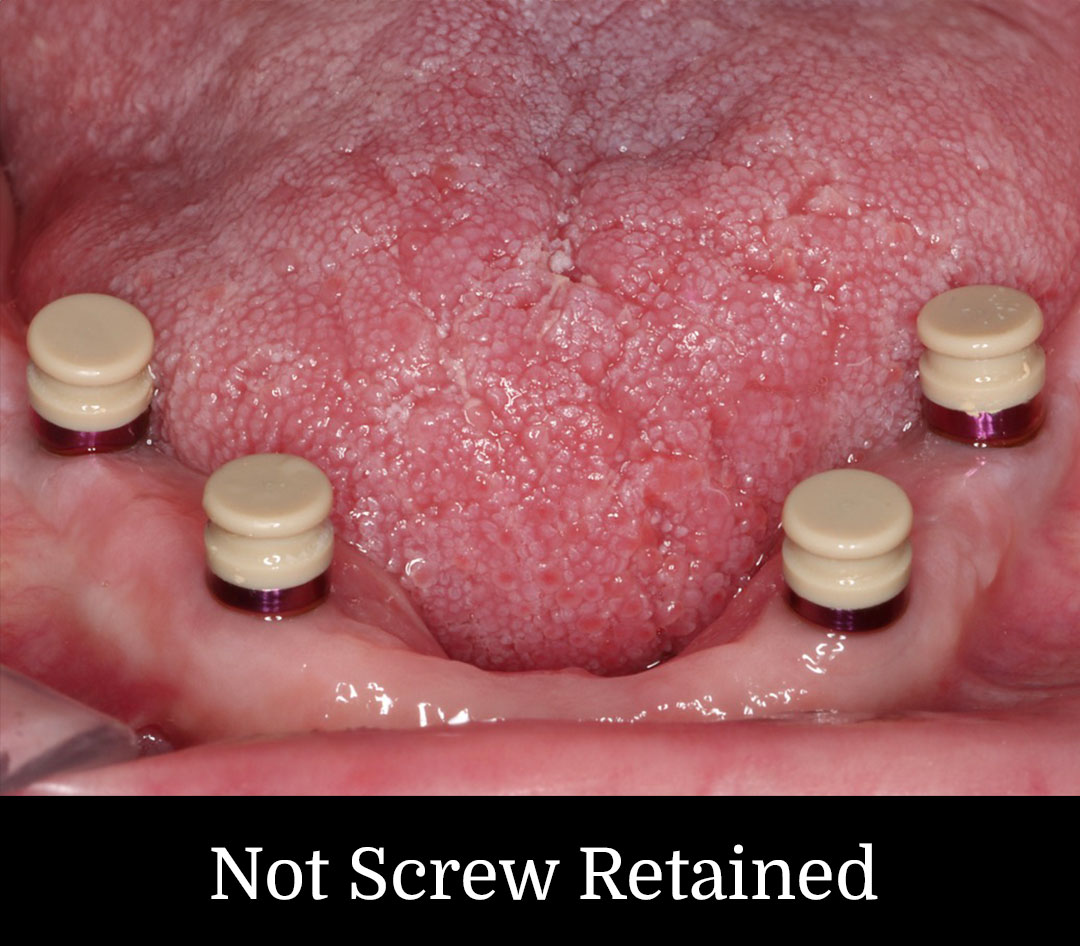 Not Screw Retained