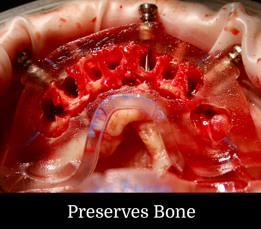 Preserves Bone