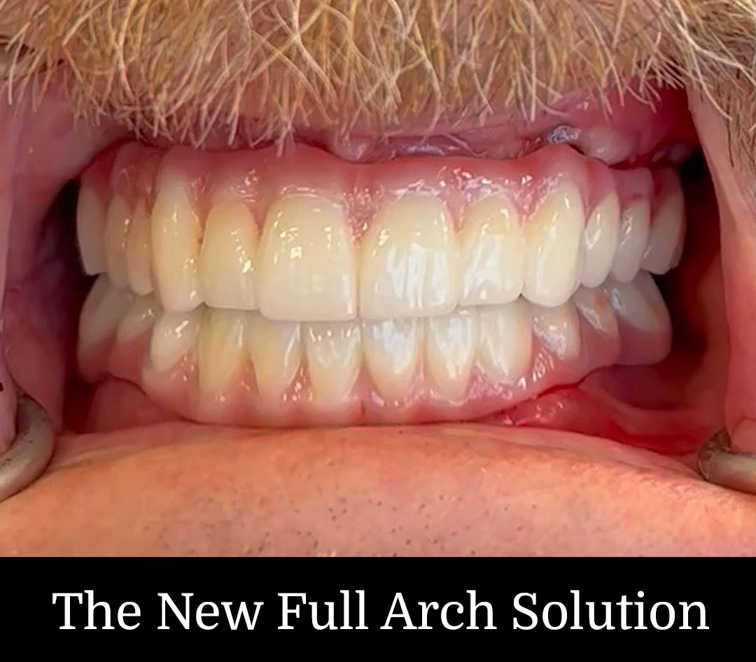 The New Full Arch Solution