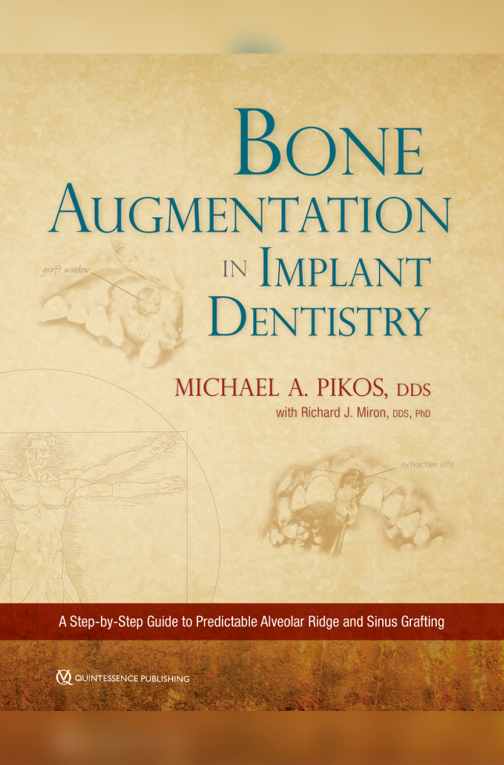 Bone augmentation in implant dentistry 