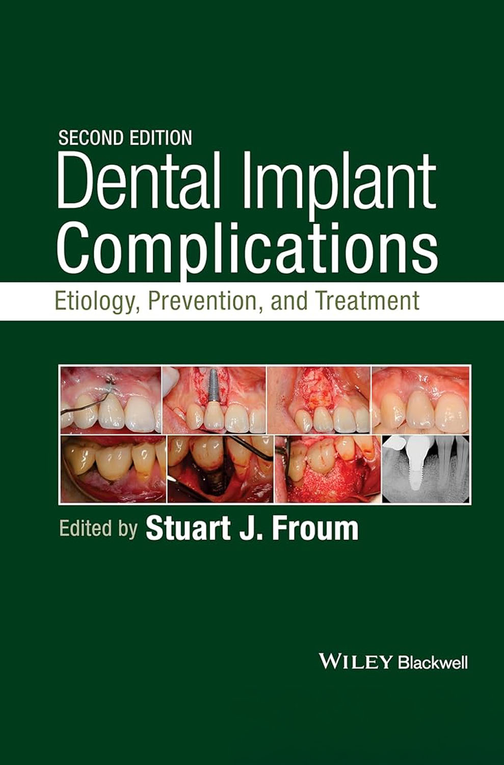 Dental implant complications Etiology Prevention and Treatment by Stuart J Froum