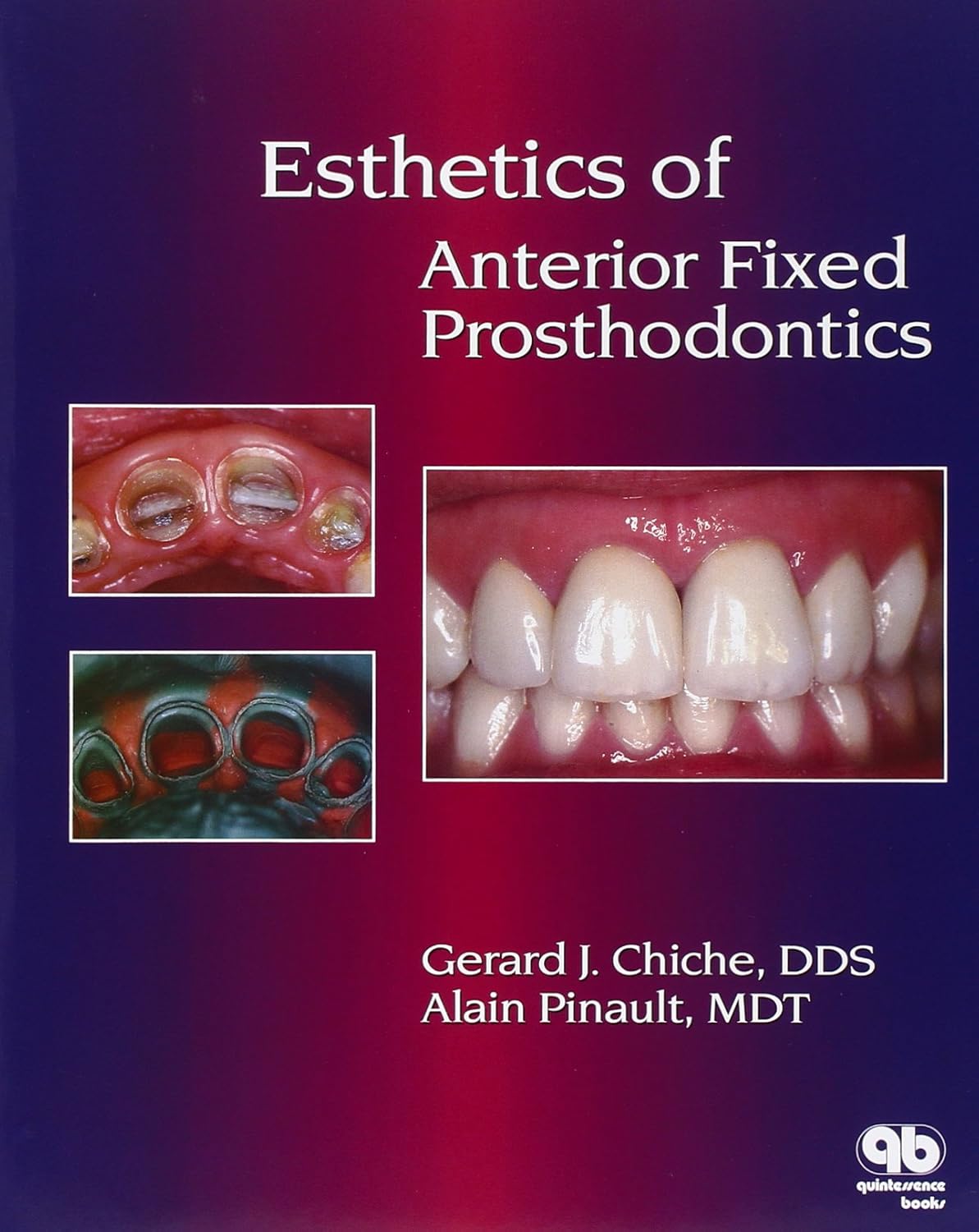 Esthetics of Anterior Fixed Prosthodontics by Gerard Chiche and Alain Pinault